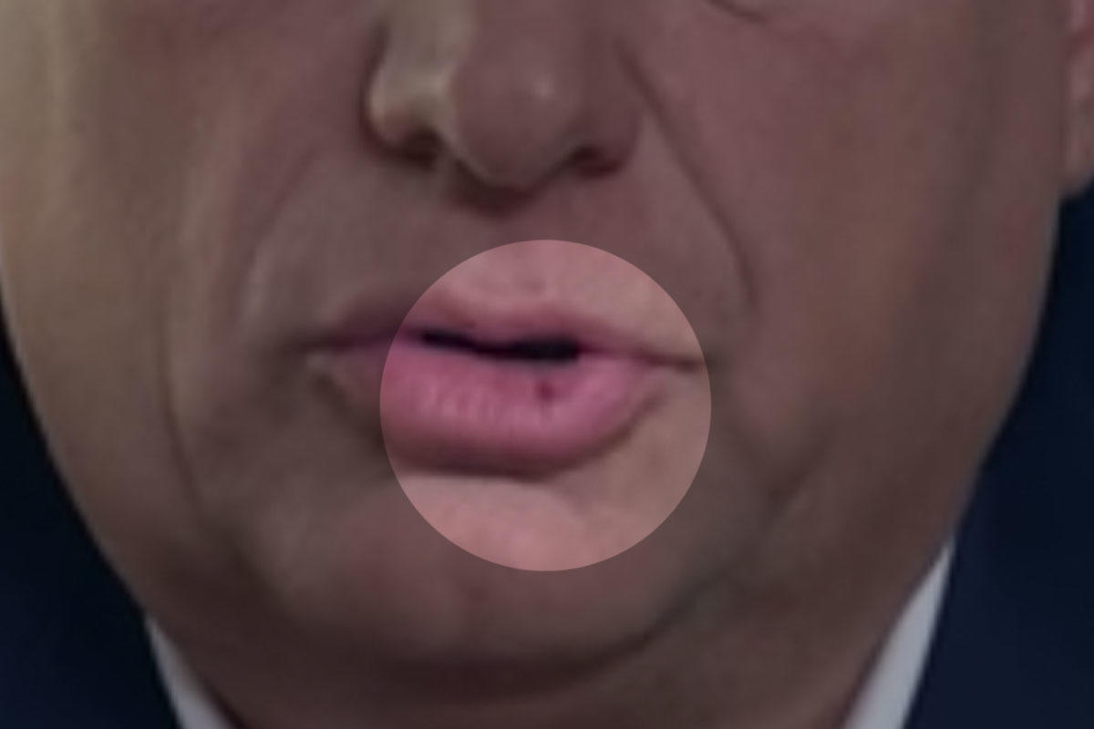 A rejtélyes folt Orbán Viktor alsó ajkán.